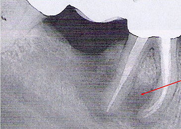 Abb. 3: Entzündung an der Wurzelspitze eines wurzelbehandelten Zahns, erkennbar an der Abdunkelung (Quelle: Dr. Graf)