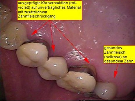 Abb. 2: Ausgeprägte Kronengingivitis und Zahnfleischrückgang im Vergleich zu gesundem Zahnfleisch
