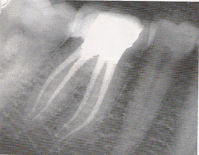 Abb. 1: Wurzelbehandelter Zahn im Röntgenbild (Quelle: Dr. Graf)