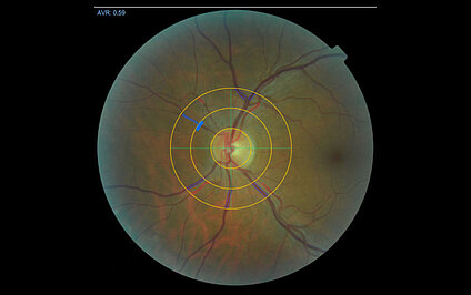 Long Covid: Diagnose aus dem Auge