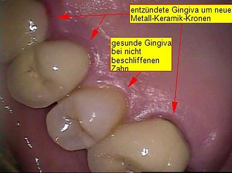 Abb. 5: Ein gesunder Zahn zwischen überkronten Zähnen
