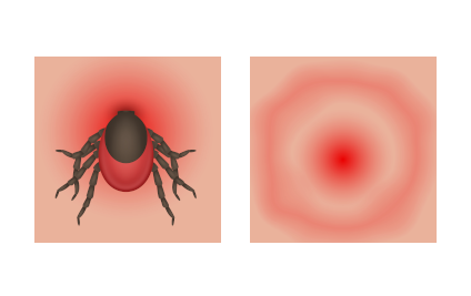 Zeckenbiss mit Hautrötung und Bissspur. Anzeichen einer Lyme-Borreliose. Illustration eines Überträgers Zeckenbiss mit Hautrötung und Bissspur. Anzeichen einer Lyme-Borreliose. Illustration eines Überträgers