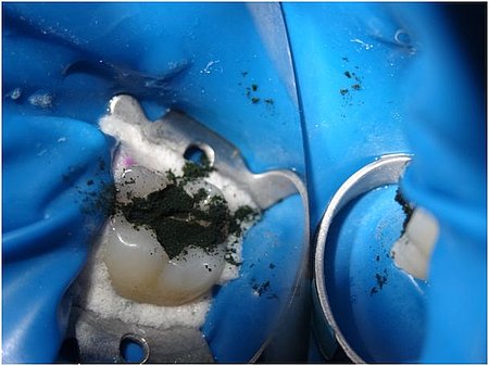 Grünliches Spirulina in der Zahnkavität, Bildquelle: Dirk Heißmeyer