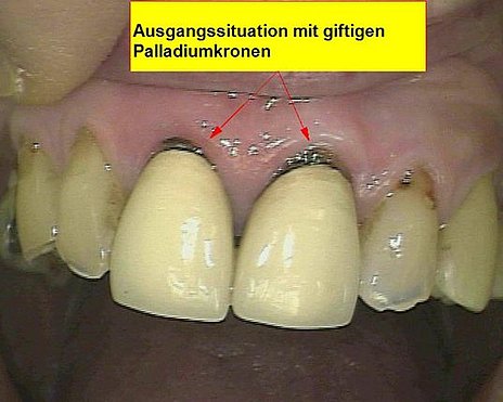 Abb. 9: Palladiumkronen mit deutlich sichtbarer Kronengingivitis und Zahnfleischrückgang