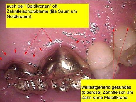 Abb. 3: Eine „Kronengingivitis“ kann auch an Goldkronen auftreten, wie der Vergleich mit gesundem Zahnfleisch zeigt.