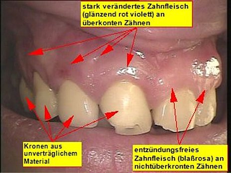 Abb. 7: Kronen mit Zeichen einer Palladiumvergiftung und gesunde Zähne