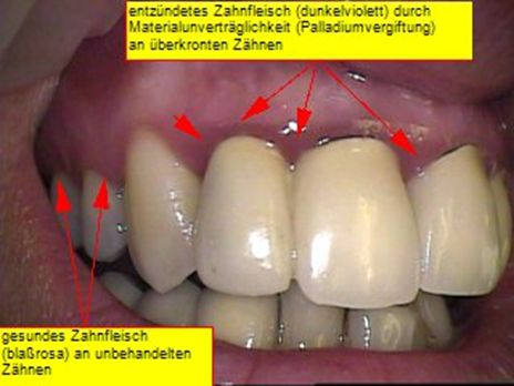 Abb. 1: Palladiumvergiftung und Kronengingivitis an den oberen Schneidezähnen (12-22), gesundes Zahnfleisch an den dahinter liegenden Zähnen (13, 14)