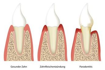 Aus einer Zahnfleischentzündung kann sich im Laufe der Zeit eine Parodontitis entwickeln. Dann drohen Zahnverlust und chronische Erkrankungen.