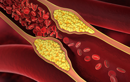 Arteriosklerose